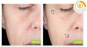 Miracle Wrinkle Filler