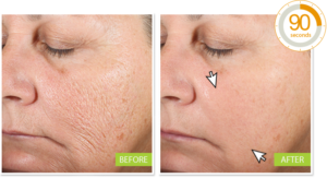 Miracle Wrinkle Filler